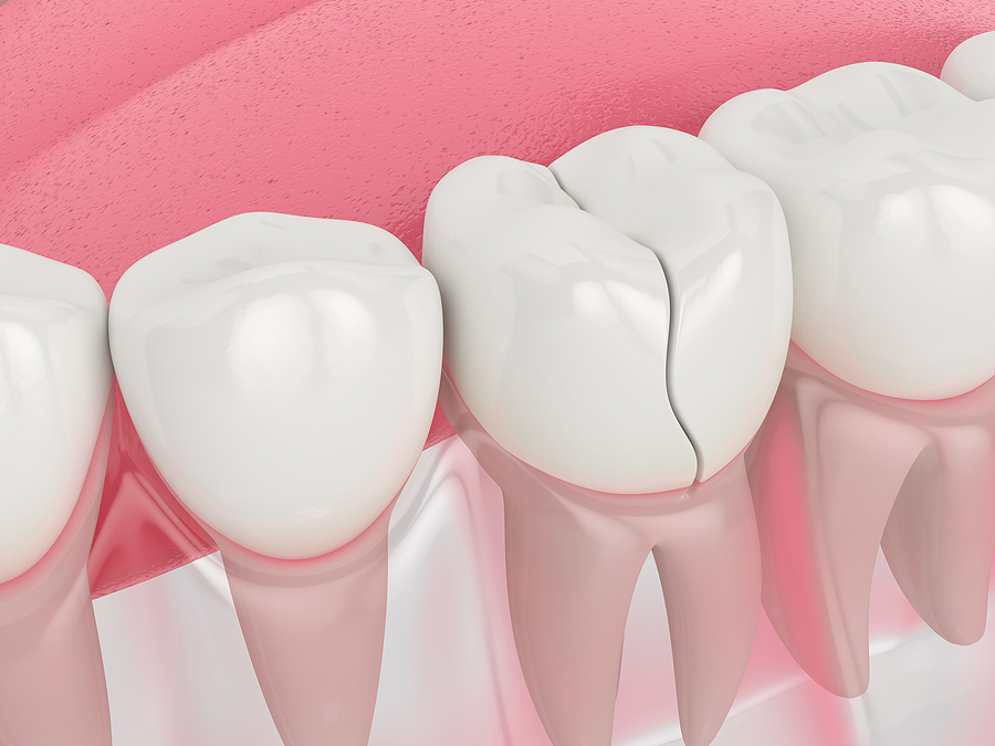 Effective Solutions for Cracked Tooth Repair in Denham Springs, LA